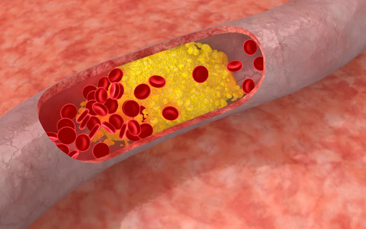 3D medical illustration showing red blood cells and yellow cholesterol buildup inside an artery